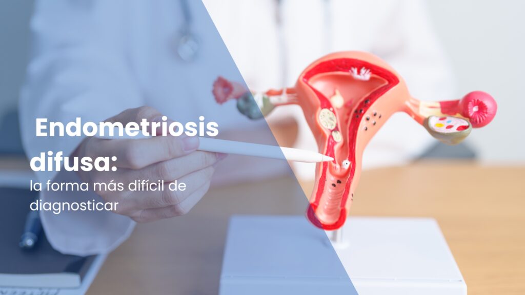 Endometriosis difusa: