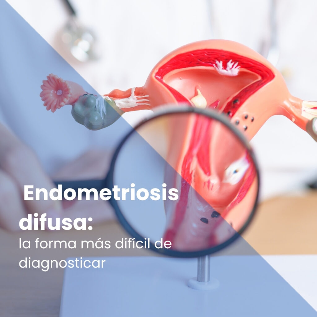 Endometriosis difusa: