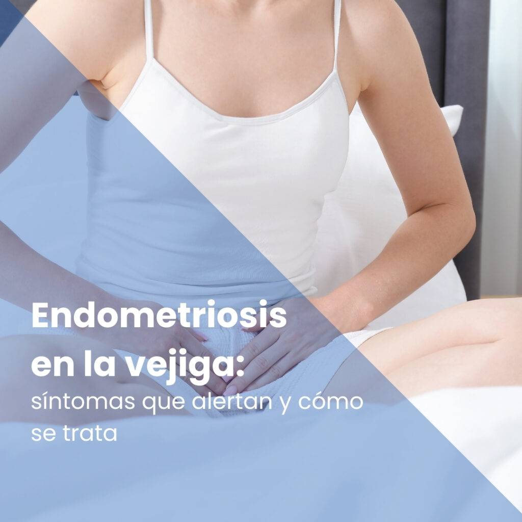 Endometriosis en la vejiga: síntomas que alertan y cómo se trata
