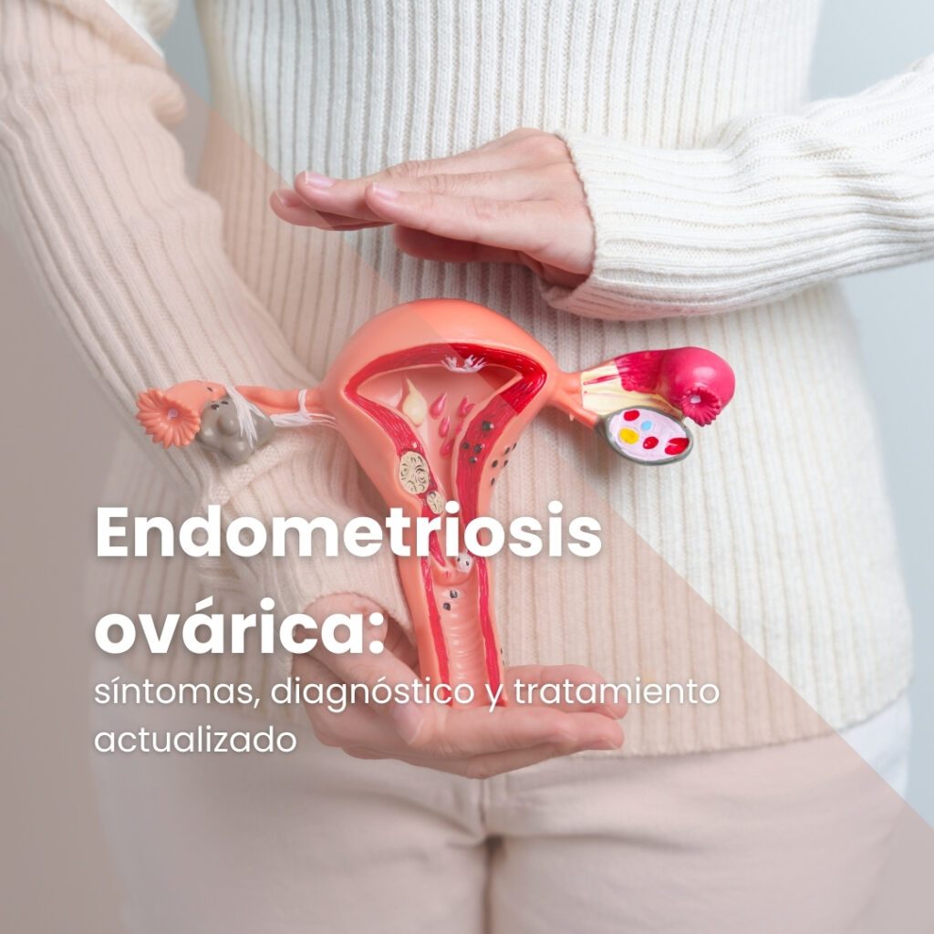 Endometriosis ovárica: síntomas, diagnóstico y tratamiento actualizado