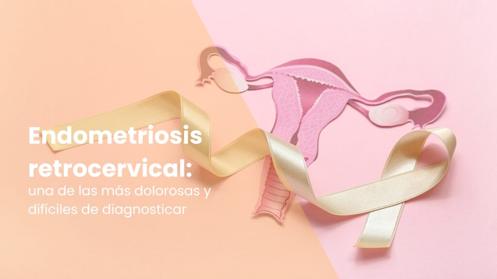 Endometriosis retrocervical: una de las más dolorosas y difíciles de diagnosticar