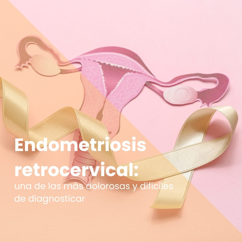 Endometriosis retrocervical: una de las más dolorosas y difíciles de diagnosticar