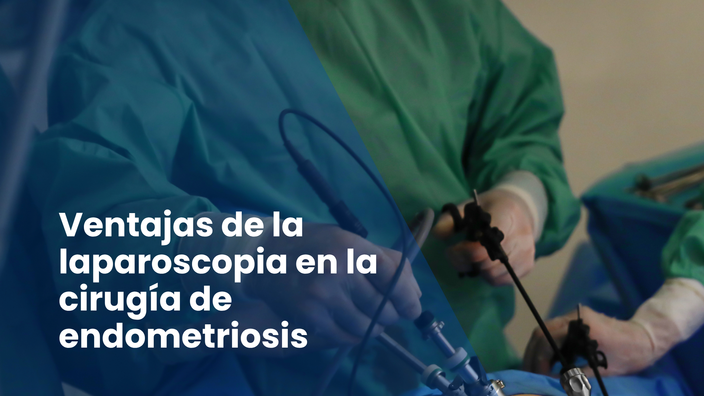 Ventajas de la laparoscopia en la cirugía de endometriosis