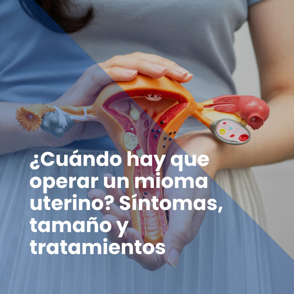 ¿Cuándo hay que operar un mioma uterino? Síntomas, tamaño y tratamientos