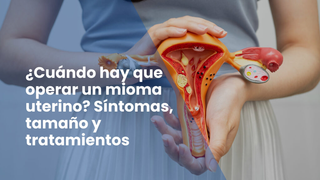 ¿Cuándo hay que operar un mioma uterino? Síntomas, tamaño y tratamientos