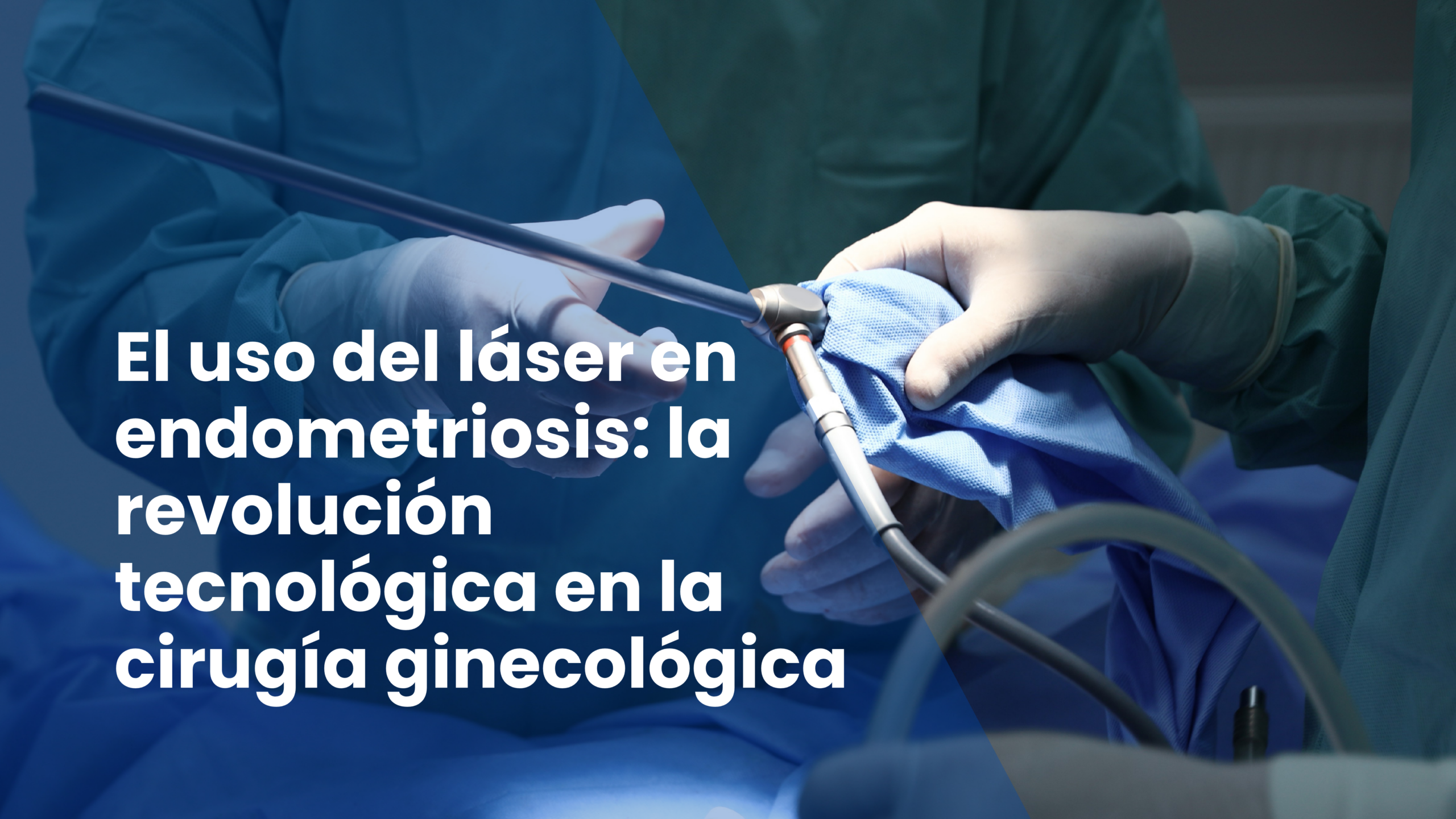 El uso del láser en endometriosis: la revolución tecnológica en la cirugía ginecológica